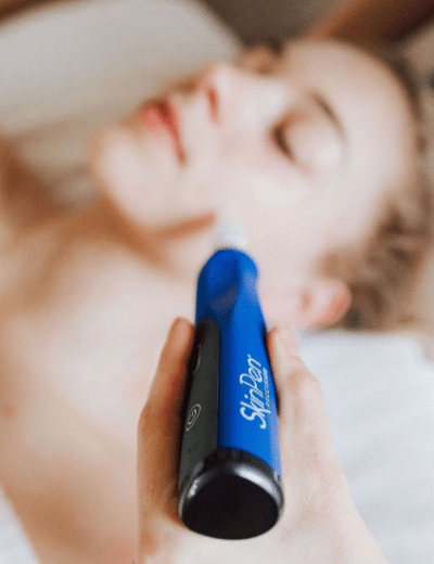 SkinPen behandling