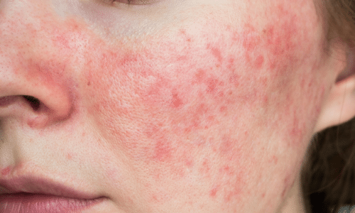 Rosacea