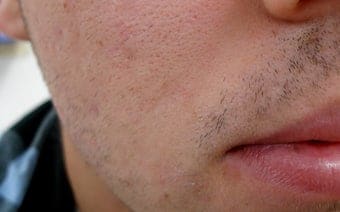 efterco2acne
