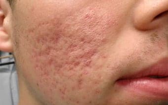 førco2acne