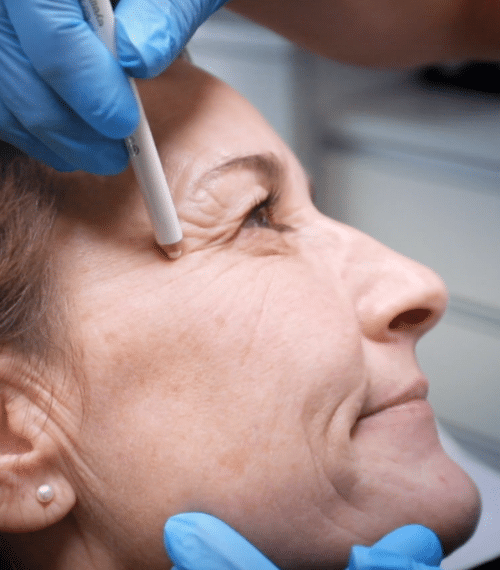 Botox behandling
