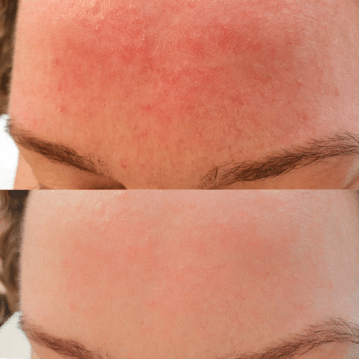 Rosacea