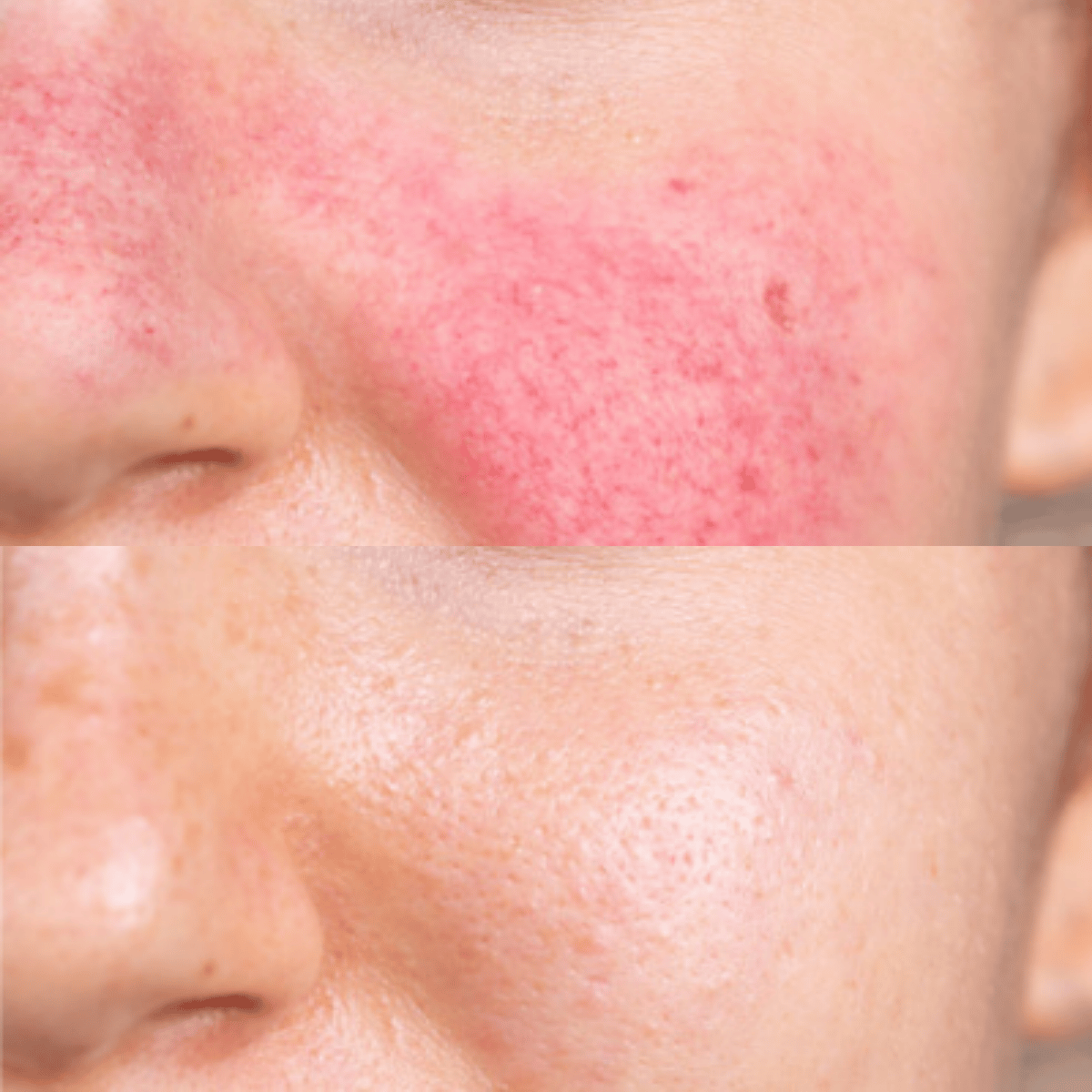 Rosacea