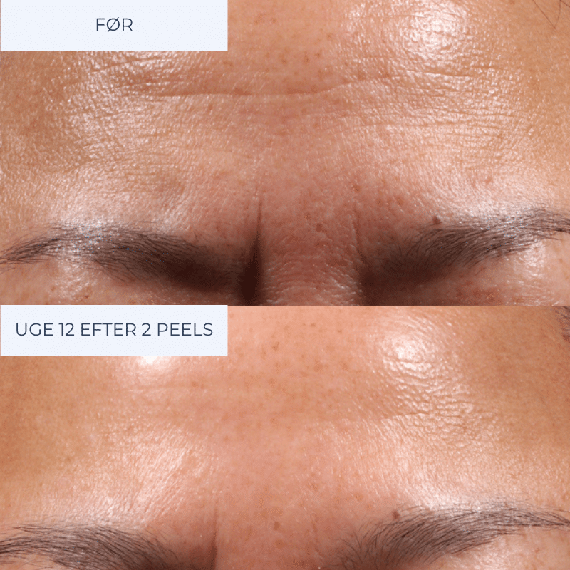 Retinol Peel
